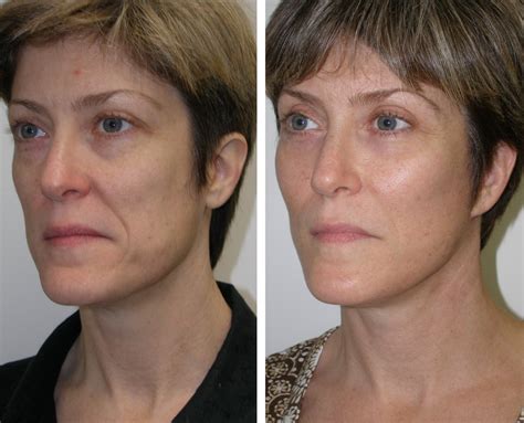 Cheek Implants Richmond VA | Facial Fillers | Midface Implants