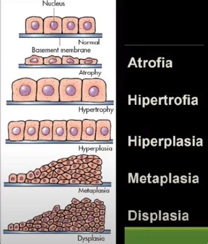 Diferença Entre Metaplasia E Displasia Jvys