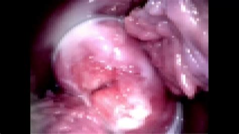 Cuzcos View Of The Cervix And Vaginal Wall Xxx Videos Porno Móviles