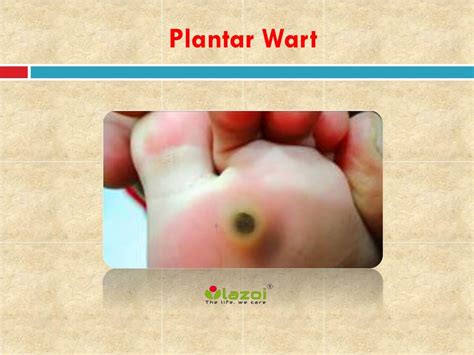 PPT - Plantar Wart: Causes, Symptoms, Daignosis, Prevention and