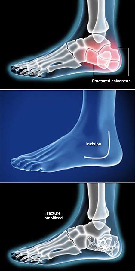 Calcaneal Fracture Fixation Open Reduction And Internal Fixation