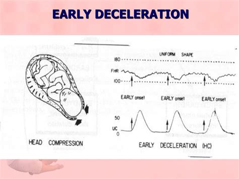 Ppt Lecture 10 Fetal Distress Powerpoint Presentation Free Download Id 5180902