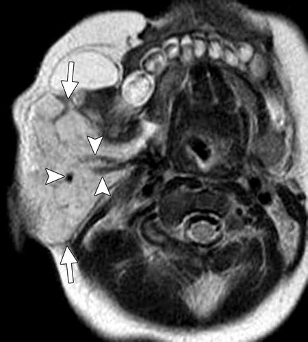 Soft Tissue Tumors Of The Head And Neck Imaging Based Review Of The Who Classification