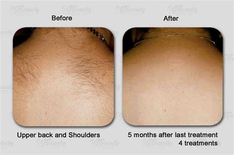 Laser Bikini Hair Removal At Alan Rayl Blog