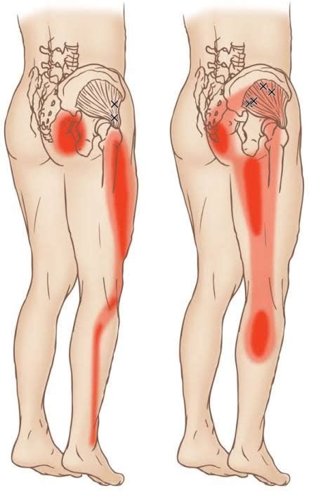 How Does Massage Gun Help With Sciatica And How To Use It