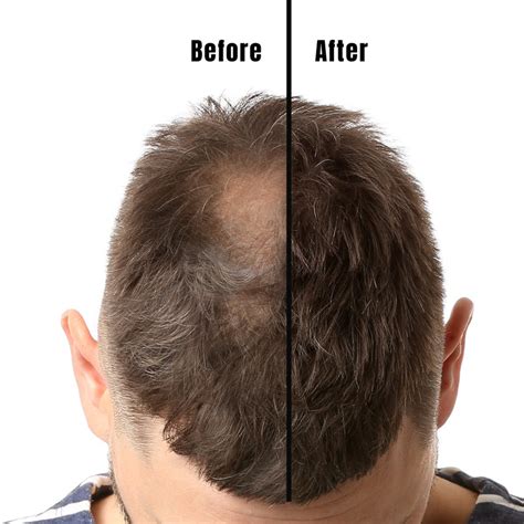 Results From Minoxidil Before And After Pictures