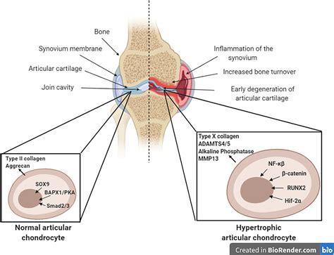 Tyrosine kinases regulate chondrocyte hypertrophy: promising drug