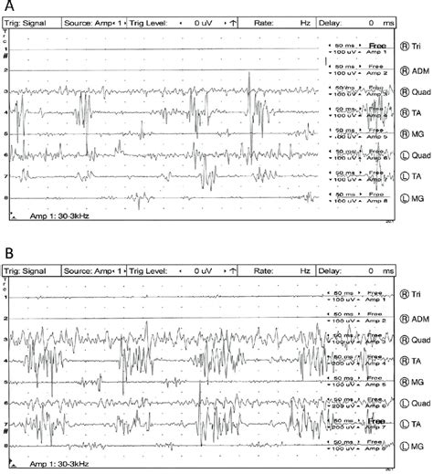 Mixed Orthostatic Myoclonus And Slow Orthostatic Tremor A While The