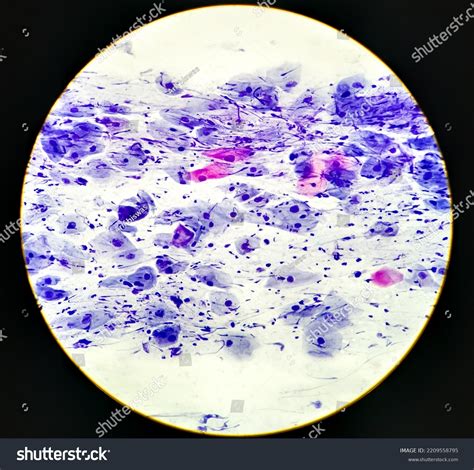 Abnormal Squamous Epithelial Cells View Microscopy Stock Photo
