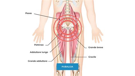 Come Curare La Pubalgia Con La Fisioterapia 3 ESERCIZI