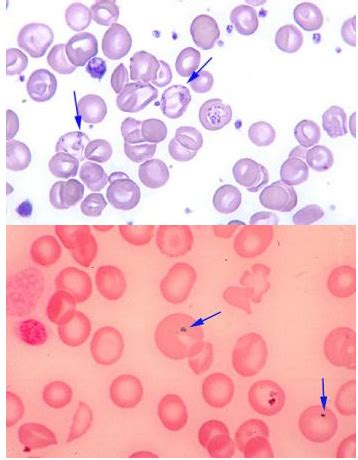 Hematology Exam Flashcards Quizlet