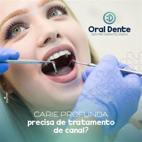 Carie Profunda Precisa De Tratamento De Canal Oral Dente