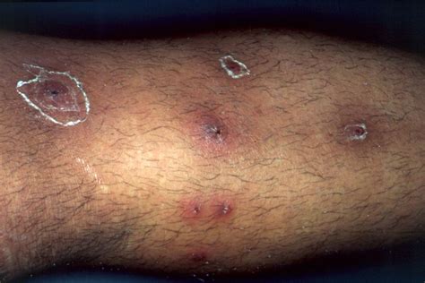 Boils Vs Cysts And How To Treat Them