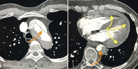 Aortic Dissection With Haemopericardium Radiology At St Vincents