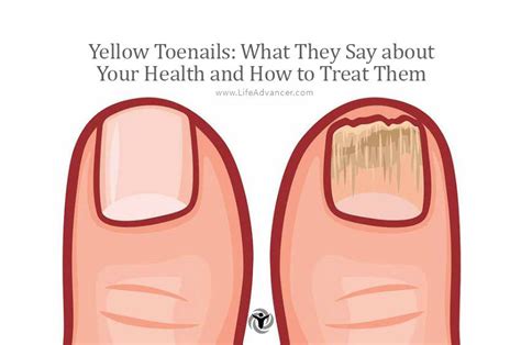 Yellow Toenails What They Say About Your Health And How To Treat Them