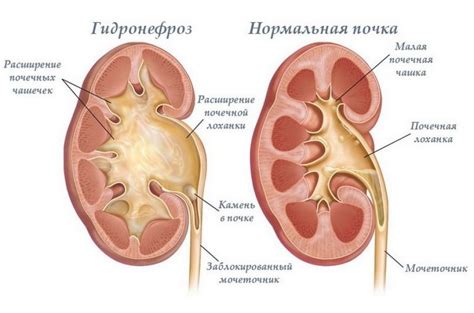 Лекарство для почек на травах: как выбрать лучшее