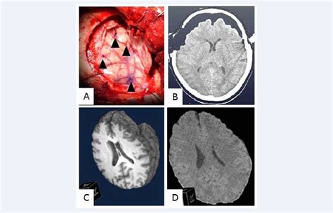 Figure From A New Brain Shift Model For Neurosurgery With Fronto