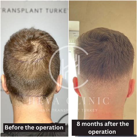 hair transplant donor area recovery  jenna stokes blog