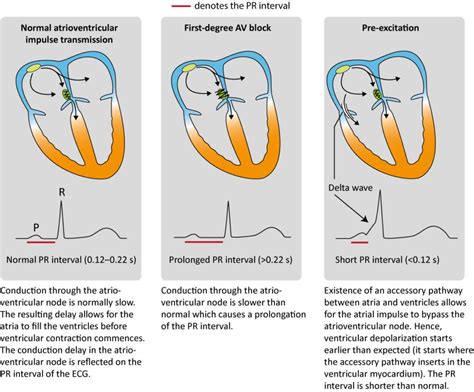 Ecg Interpretation Characteristics Of The Normal Ecg P Wave Qrs