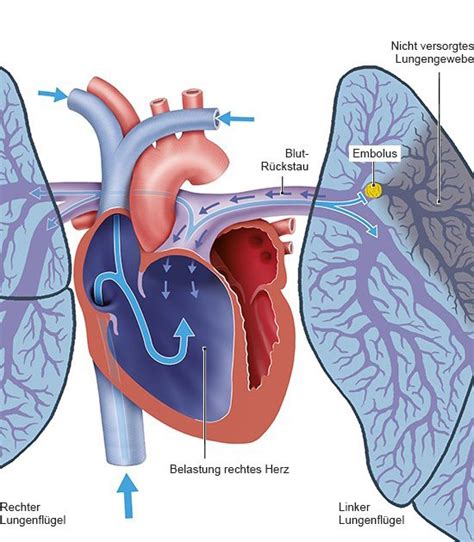 Lungenembolie Gesundheitsinformation De