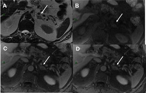 SciELO Brasil Enhancement Patterns Of Adrenal Nodules On Magnetic