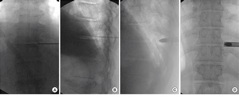 Figure From Uniportal Transforaminal Endoscopic Thoracic Discectomy