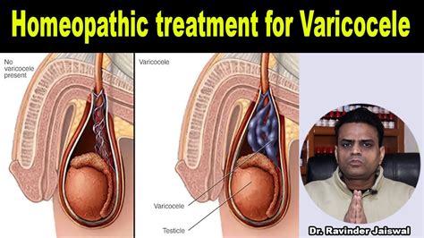 Varicocele Symptoms Causes And Homeopathic Treatment Dr Ravinder