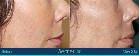 Secret Rf Micro Needling Genuineu Md