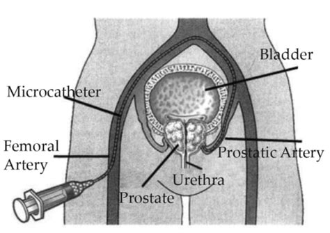 Prostate Artery Embolization Pae In Fredericksburg Va