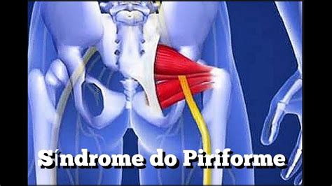 S Ndrome Do Piriforme Youtube