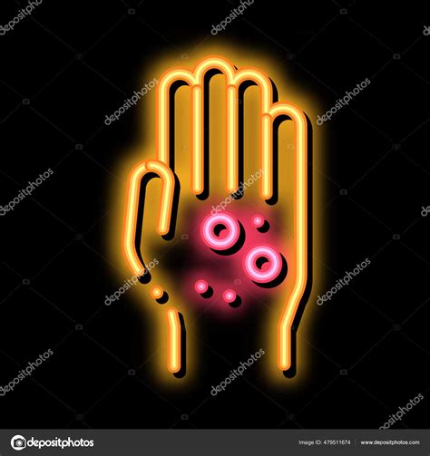 Dermatitis Rash On Hands Neon Glow Icon Illustration Stock Vector By