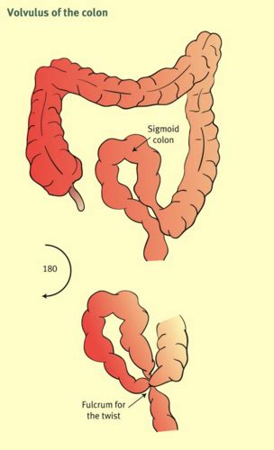 Mechanical Developmental And Vascular Disorders Of The Lower Gi Tract