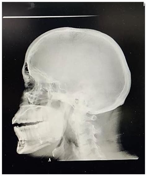 Post Operative Lateral Ceph Radiograph Case 1 Download Scientific