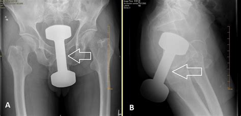 Patient Tried To Use A Five Pound Dumbbell As A Dildo And This Happened R Dildont