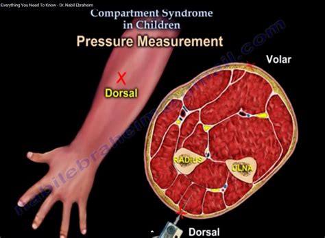 Compartment Syndrome In Children —