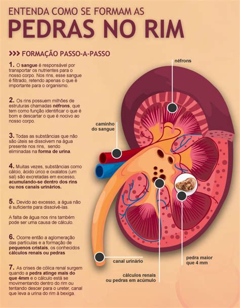 O Que Provoca Pedra Nos Rins - Pedra Nos Rins: Sintomas, Como É A Dor E Tratamento – FMYRX
