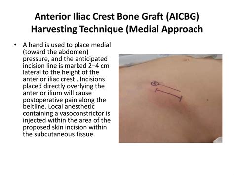 Anterior Iliac Crest Ppt