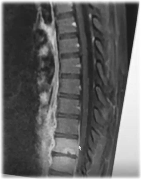 Epidural Abscess And Paravertebral Abscess Download Scientific Diagram