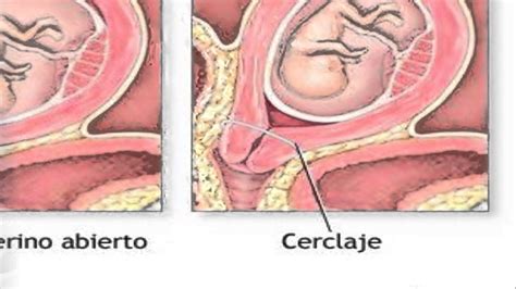 Incompetencia Stmica Cervical Y Cerclaje Youtube