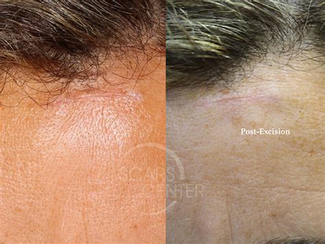 Foreign Body Granuloma Of Forehead Skin Cancer And Reconstructive