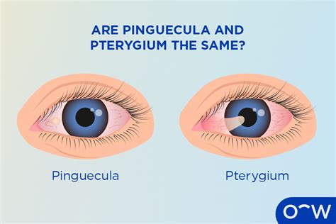 Pinguecula Causes Symptoms Diagnosis And Treatment