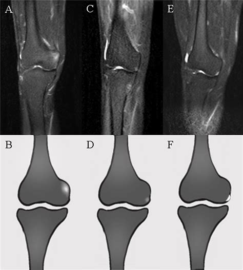 Iliotibial Band Syndrome Mri