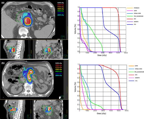 An Example Of Isodose Distributions And Dvhs For Two Representative