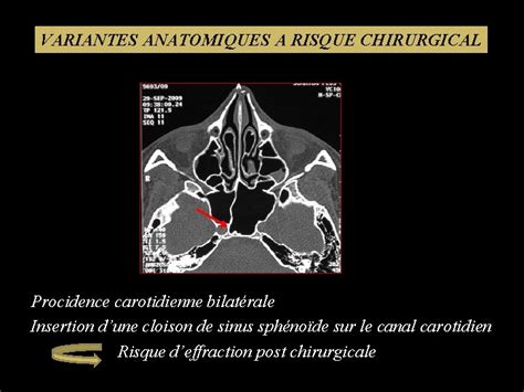 Illustration Tdm Des Variantes Anatomiques Des Sinus De