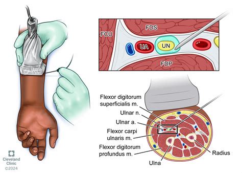 Ultrasound Guided Nerve Blocks For Flexor Tenosynovitis Pocus Journal