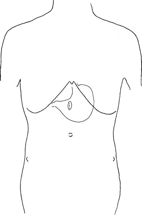 An Illustrated Diagram Of The 4 Cm Midline Incision And The 1 5 Cm