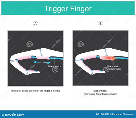 Trigger Finger Illustration Explain A Symptom Of Locked Finger Caused