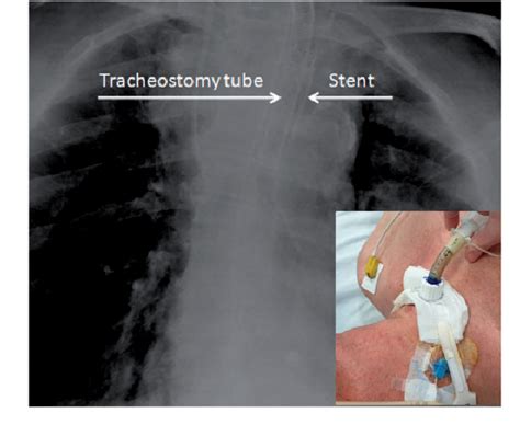 Figure 2 From Percutwist Tracheostomy In An Intubated Patient With