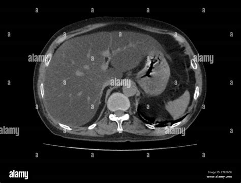 Liver Black And White Stock Photos And Images Alamy
