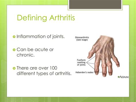 Ppt Arthritis Powerpoint Presentation Free Download Id2856354